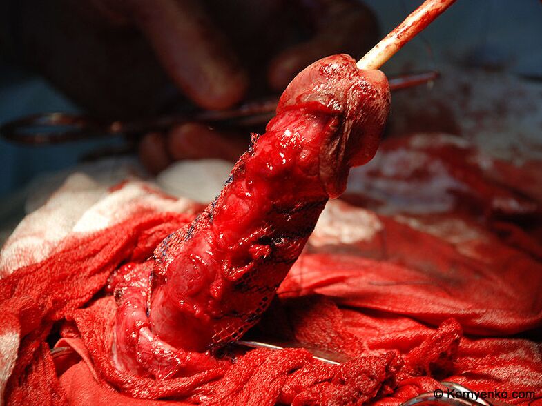 installatie van een collageenmatrix voor penisvergroting