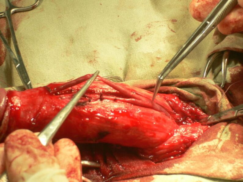 lipofilling van de penis voor vergroting