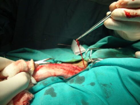 operatie voor penisvergroting